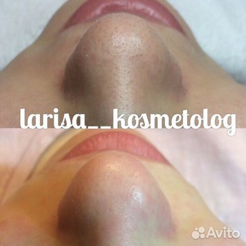 Чистка лица Чистка лица