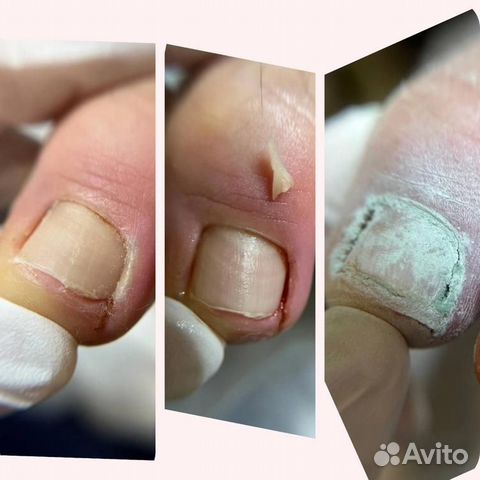 Вросший ноготь коррекция