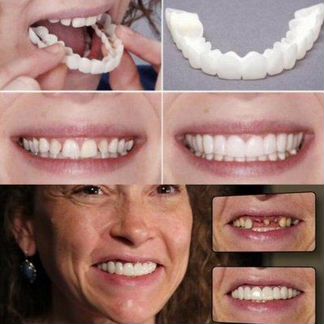 Виниры Snap-On Smile